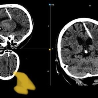 Descubren que una mujer vivió 80 años con una aguja en su cerebro